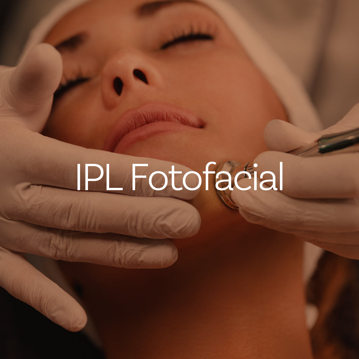 IPL Fotofacial (AZ Only)